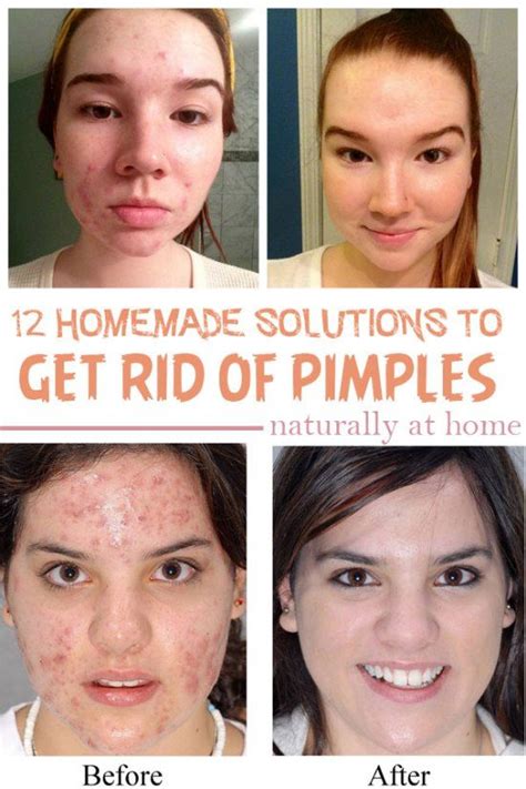Get Rid Of Pimples At Home Naturally How To Get Rid Of Pimples