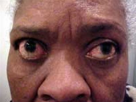 Graves' disease is an autoimmune disease where the thyroid is overactive, producing an excessive amount of thyroid hormones (a serious metabolic imbalance known as hyperthyroidism and. Medical Pictures Info - Graves Disease