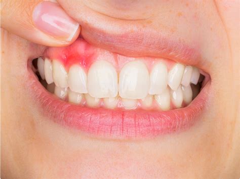 Synthetic Peptide Resolves Gingivitis Inflammation In Three Weeks