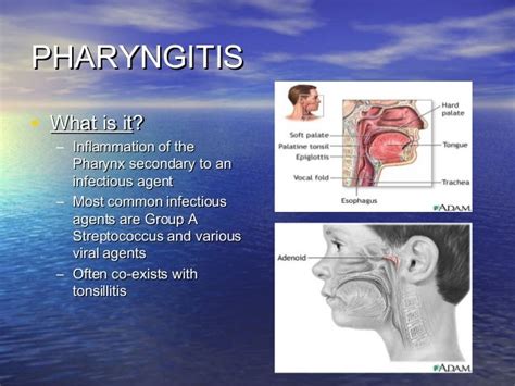 Pharyngitis As Related To AlstrÃ¶m Syndrome Pictures