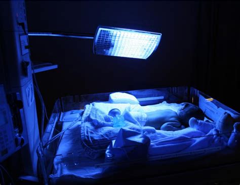 नवजात शिशु मा जण्डिश Jaundice In Newborn निरोगी नेपाल मा स्वागत छ