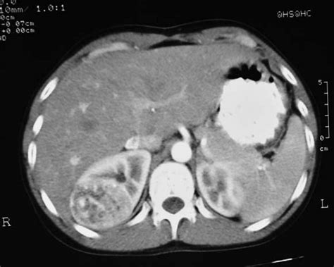 Ultrasound And Ct Imaging Assessment Of Renal Angiomyolipoma Bmj Case