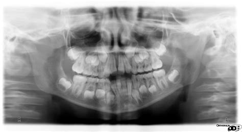 Dental X Rays The Whole Tooth Pediatric Dental Blog