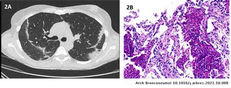 Eosinophilic Pneumonia Associated To Sars Cov 2 Vaccine Archivos De