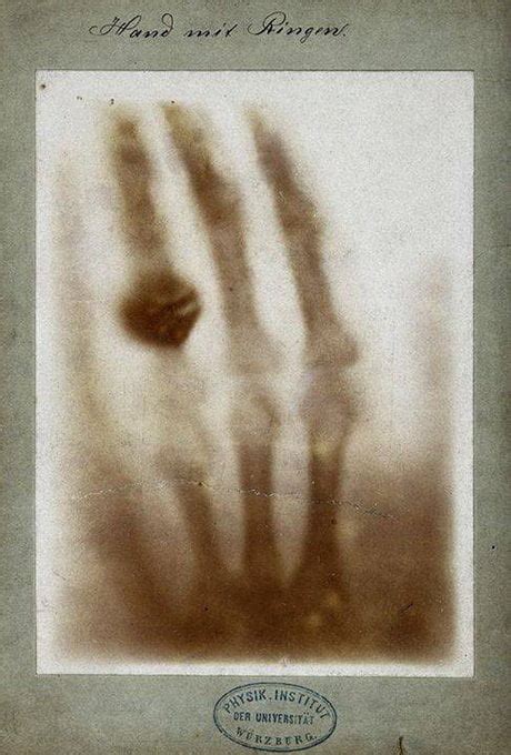 This is the first ever X ray image it was taken in by Wilhelm Röntgen GAG