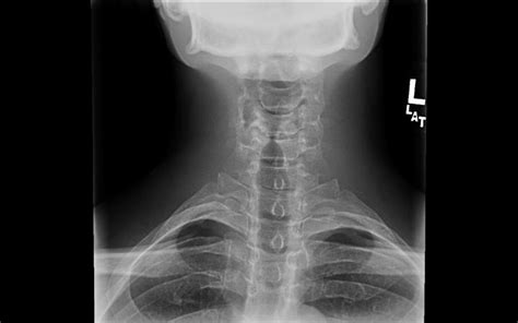 Cervical Spine Trauma Evaluation Spine Orthobullets