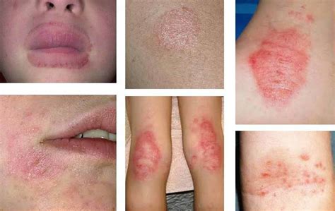 Fungal Infections Natural Remedies For Fungal Infections Healthy