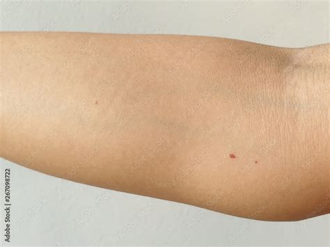 Cherry Angiomas On Arm Skin Red Dot Suddenly Appeared Foto De Stock