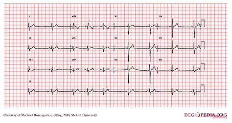 Left Posterior Fascicular Block Electrocardiogram Wikidoc