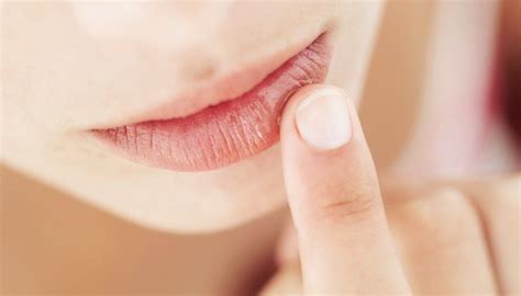 How To Heal Cracked Lip Corners Fast Cure Chapped Lips