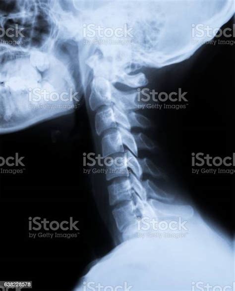 Xray Of The Neck And Skull Side View Stock Photo Download Image Now