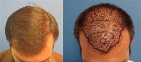 Check spelling or type a new query. Mens Before and After Hair Transplant Photos