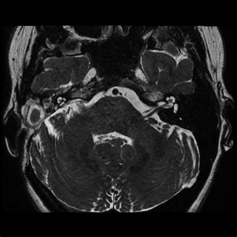 Right Vestibular Schwannoma In 27 Year Old Woman Dr Sean Flanagan