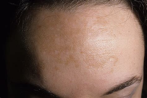 Melasma On Face Pictures 23 Photos And Images