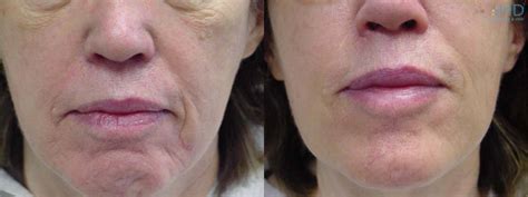 Juvederm For Nose To Mouth Lines Baltimore Md