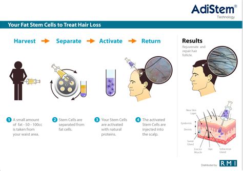 Treatment For Hair Restoration Stem Cell Therapy For Hair Restoration