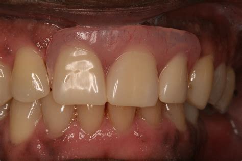 Clinical Case 2 - Blue Wolf Dental