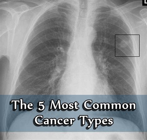 The 5 Most Common Cancer Types Hubpages
