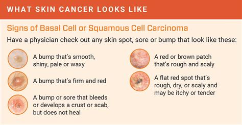 How To Check Yourself For Skin Cancer Respectprint22