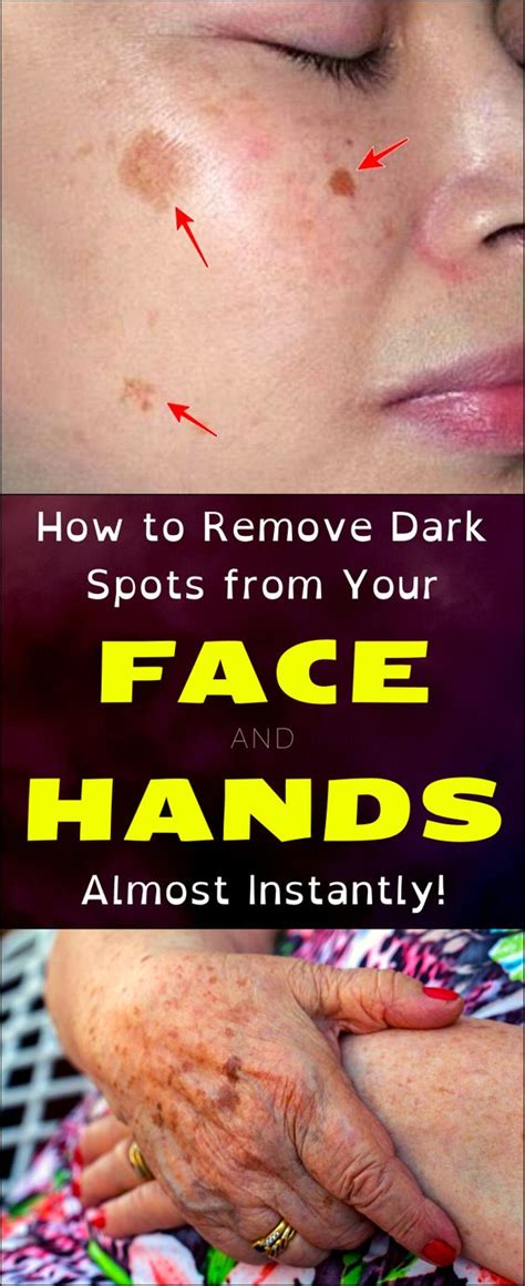 How To Remove Dark Spots From Your Face And Hands Instantly Overnight