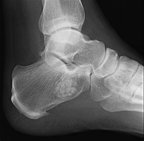 Symptomatic Intraosseous Lipoma In The Calcaneus Anticancer Research