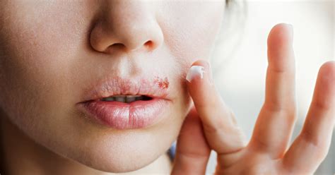 Cold Sores On Toddlers Lipstick