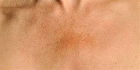 Causes And Treatments For Hyperpigmentation Under The Arms Justinboey