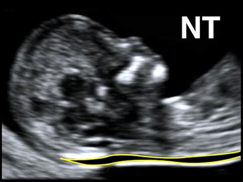 Major heart problems can also be detected using the nt prenatal test. Nuchal translucency screening - buzzpls.Com