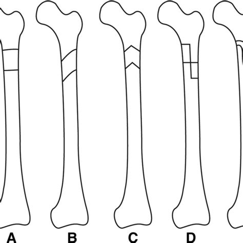 Types Of Subtrochanteric Osteotomy A Transverse B Oblique C