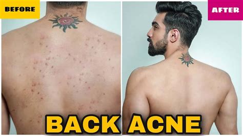Pimples On Back Archives Pimple Popping Videos