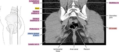 Ct Of The Female Pelvis Radiology Key