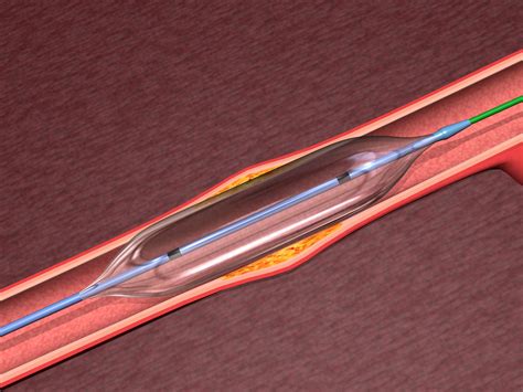 Drug Coated Balloon Angioplasty Noninferior To Drug Eluting Stent For