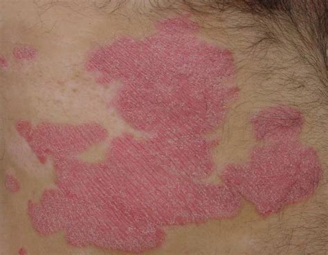Le macchie rosse sulla pelle | DoctiCare.it