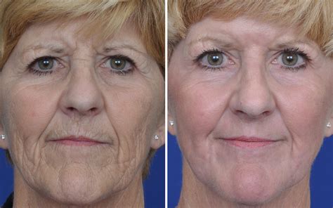 Laser Skin Resurfacing Before And After Annapolis Plastic