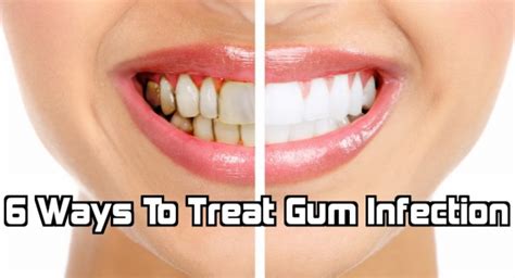 6 Ways To Treat Gum Infection Pymble Dentist