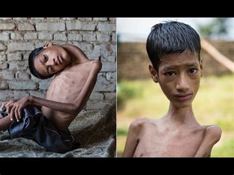 Read 2 reviews from the world's largest community for readers. Boy Born With 'Upside Down Head' Tragically Dies - YouTube