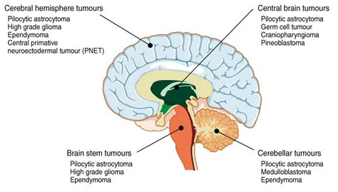 Disease Graphics Videos And Images On Brain Cancer