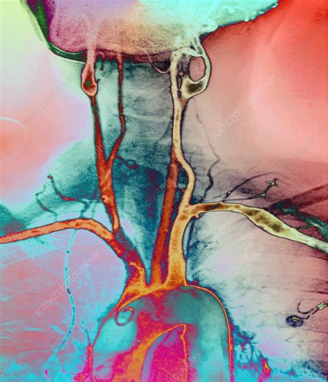 The procedure is noninvasive and. Chest and neck arteries, X-ray - Stock Image - P206/0269 ...