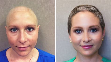 Chemo Hair Loss Eyebrows Chemo Patient Says Eyebrow Gel Helped Her
