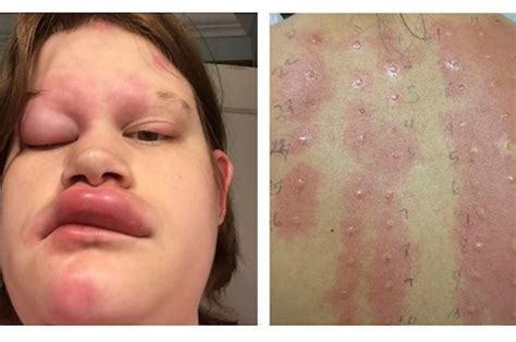 31 Allergic Reactions That Actually Hurt To Look At