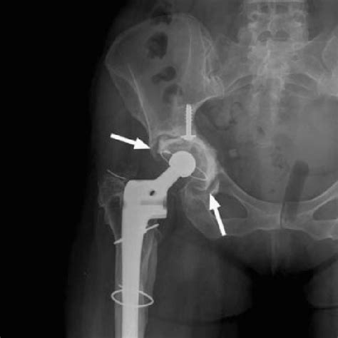 Right Total Hip Replacement With Loosening Of The Acetabular Component