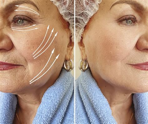 Face Old Woman Wrinkles Problem Before And After Treatment Arrow