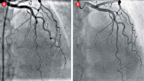 Angiogram Of The Left Anterior Descending Lad Coronary Artery In The