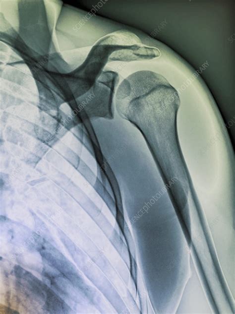 Normal Shoulder X Ray Stock Image F0039195 Science Photo Library