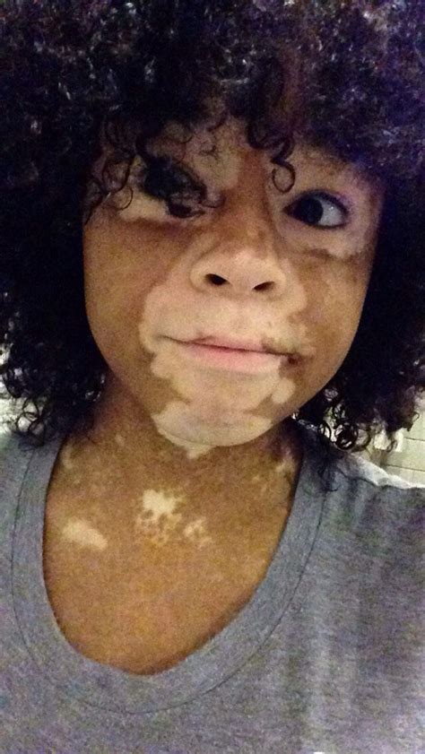 Am I Cute Or Naw Vitiligo Vitiligo Treatment Laser Treatment