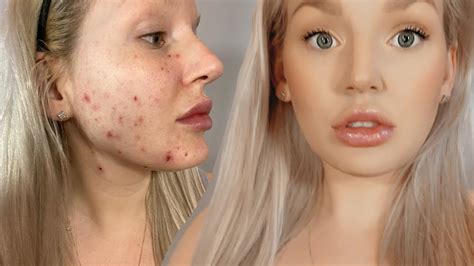 How To Cover Acne Blemishes And Redness Youtube