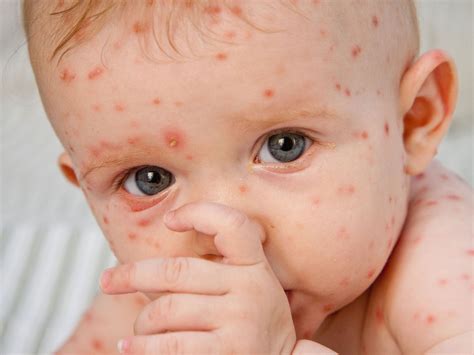 For this, two doses of the vaccine must be given at least four weeks apart. Chickenpox - Hueneme Family Pharmacy
