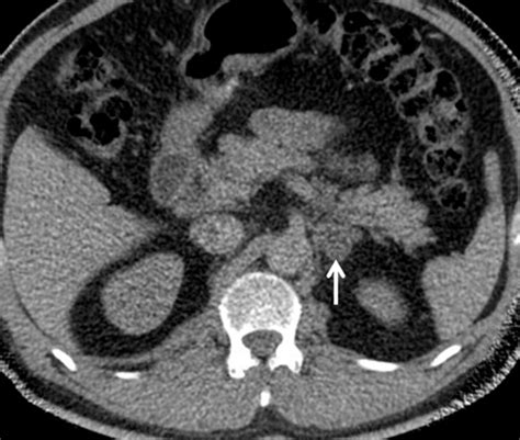 Adenoma Characterization Adrenal Protocol With Dual Energy Ct Radiology