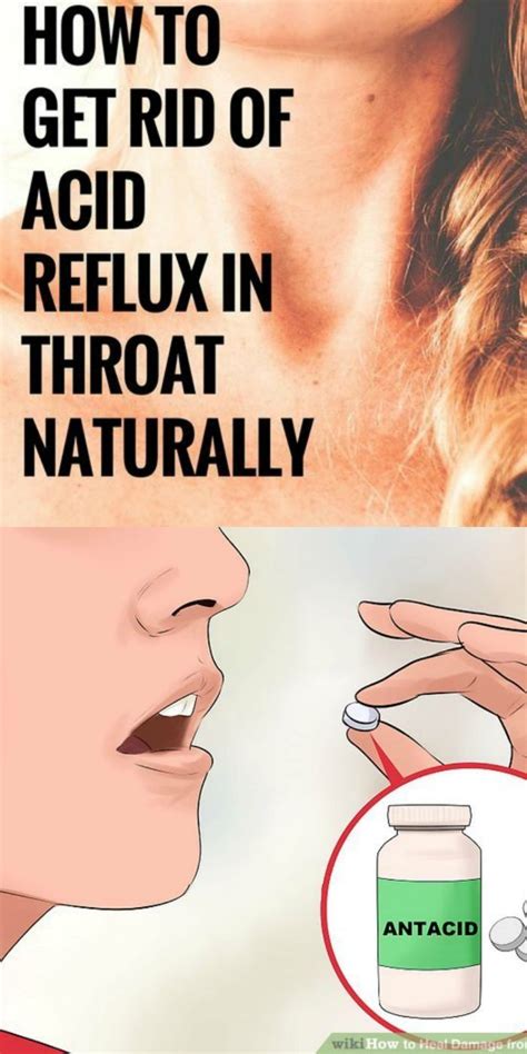 These medications help get rid of stomach acid and ease mild heartburn. Pin on treating acid reflux naturally