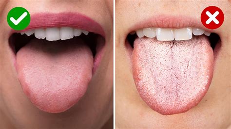 5 Things A White Tongue May Reveal About Your Health Power Of Positivity